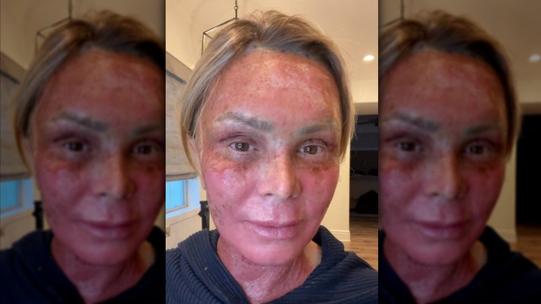Tamra Judge documents her procedure recovery