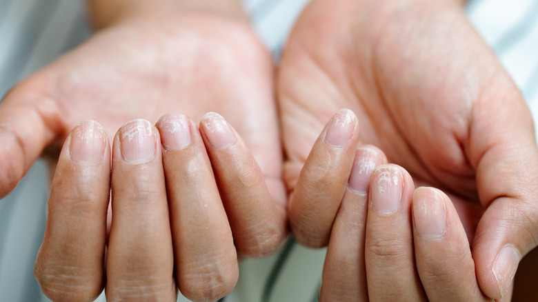 brittle nails 