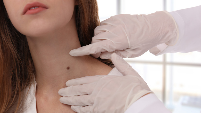 Woman's birthmarks being examined