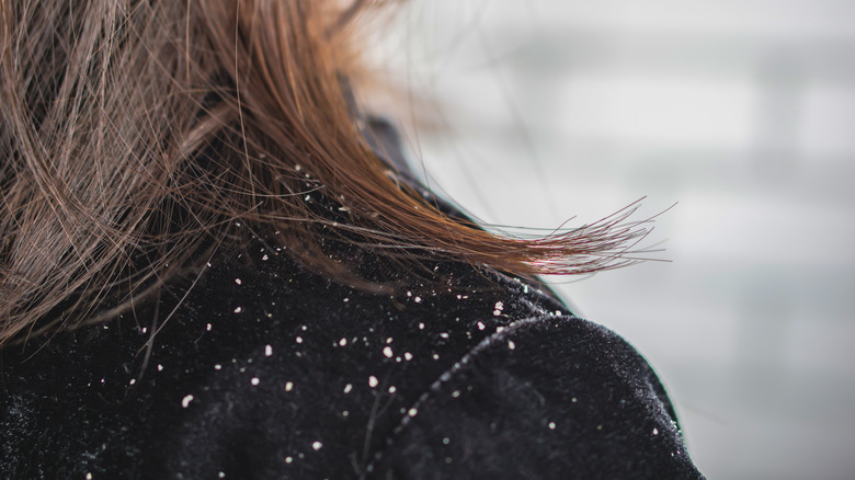 Woman with dandruff on shoulder