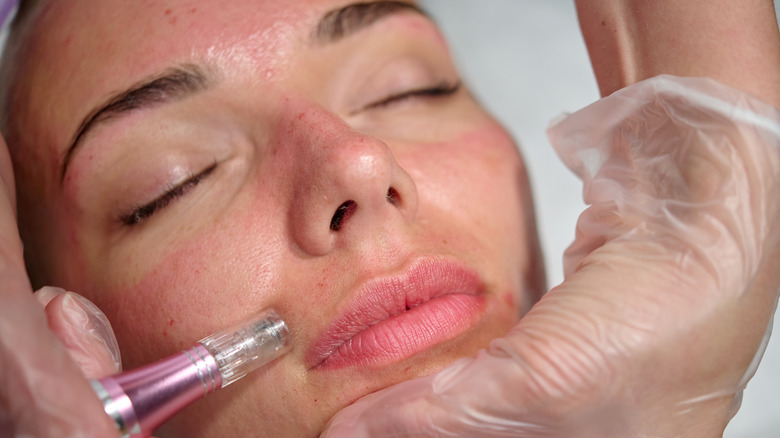 woman microneedling