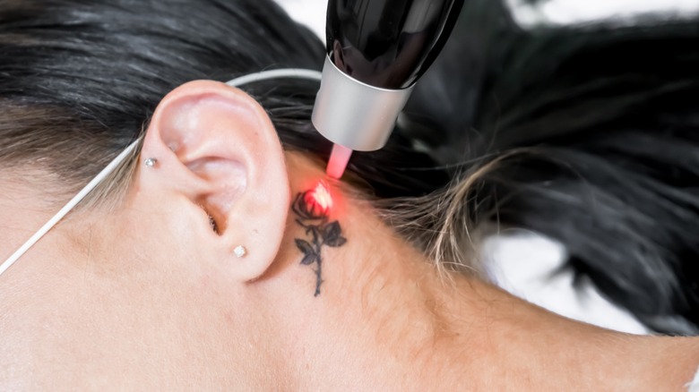 Removing rose tattoo on neck