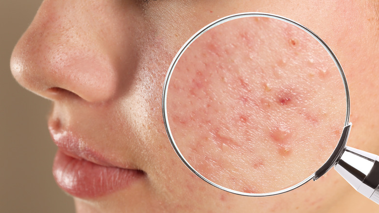 female acne 