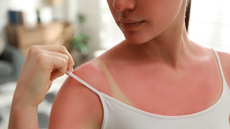 woman with a sunburn