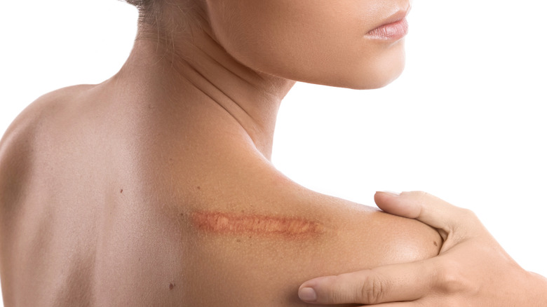skin wound on woman