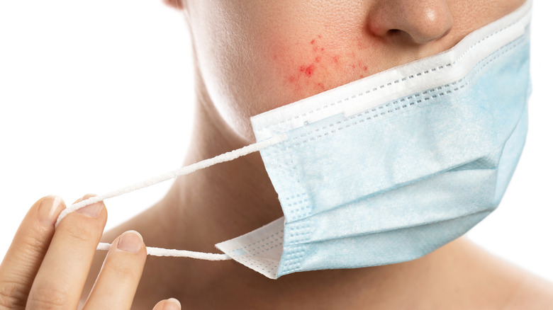 Person removing face mask to reveal acne breakout