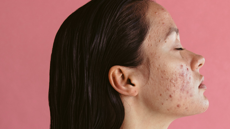 side profile of woman's acne