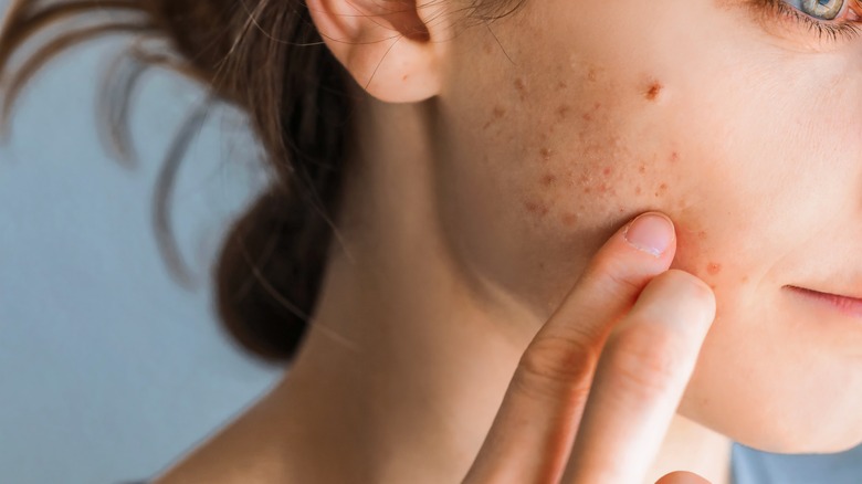acne on cheek