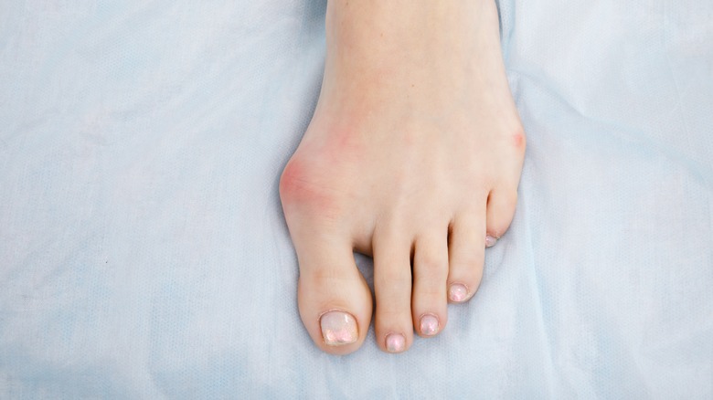 Woman's foot with bunion
