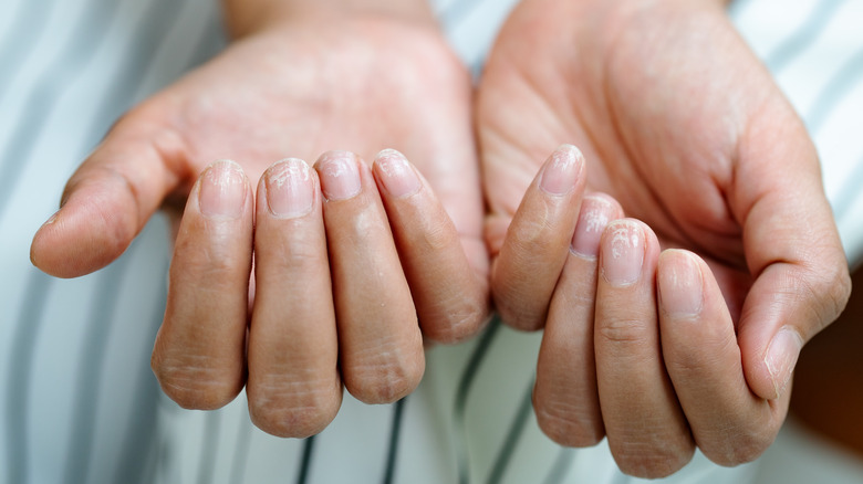 damaged brittle nails