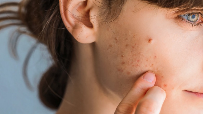 Close up of model applying acne treatment