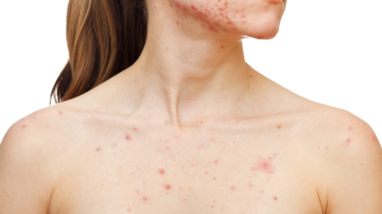 What Causes Chest Acne And How To Get Rid Of It