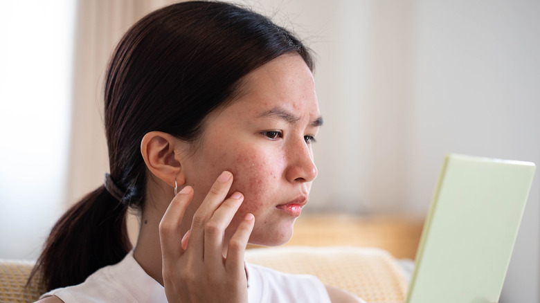 Person suffering from cystic acne.