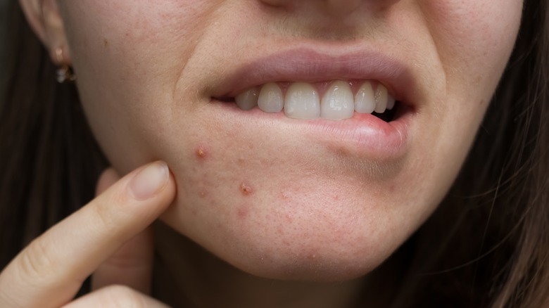 female acne near the lip