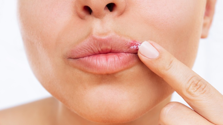 Woman touching irritated lip