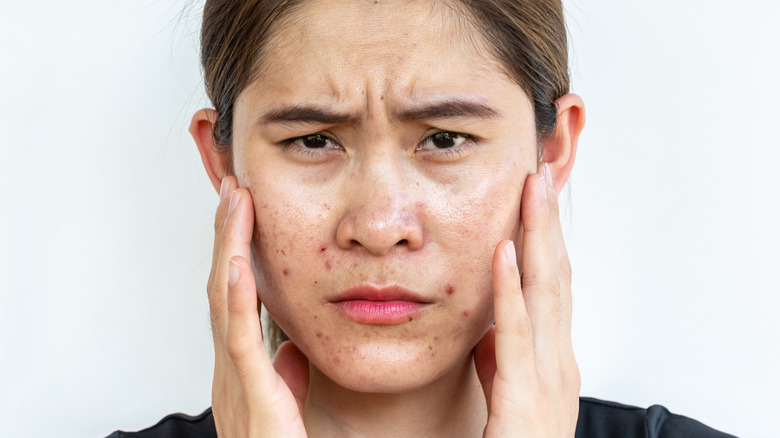 Asian female with pimples