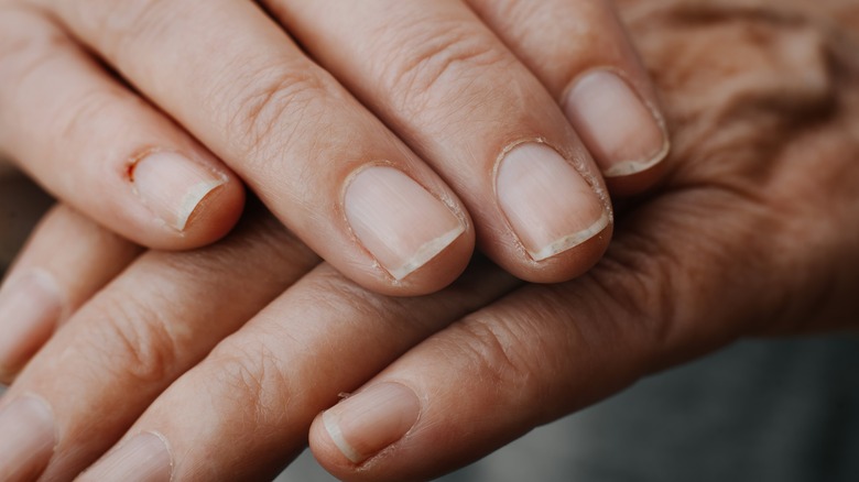 dry skin around nails