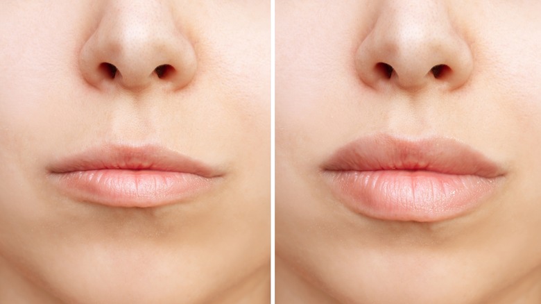 Lip flip before and after