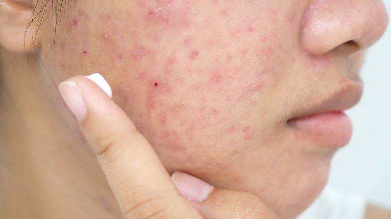 woman applying acne treatment