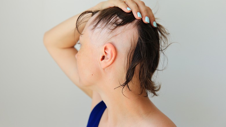 Woman with alopecia hair loss