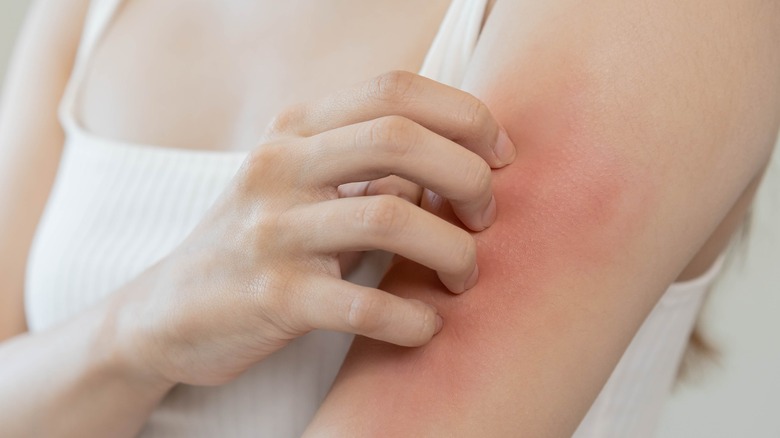 Woman scratching rash 