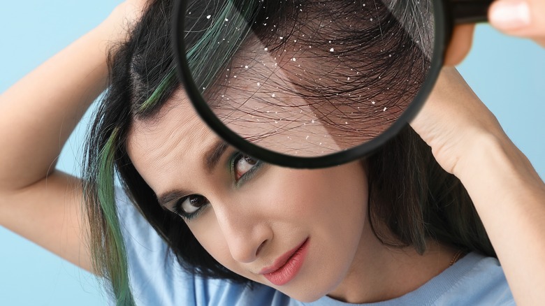 Female dandruff under magnifying glass
