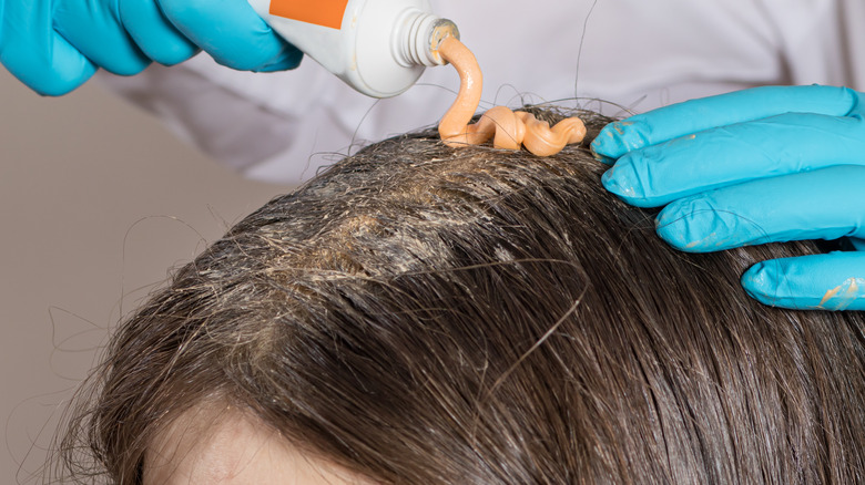 What Is Scalp Malassezia And How Can You Treat It?