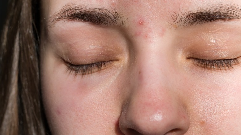 pimples between eyebrows