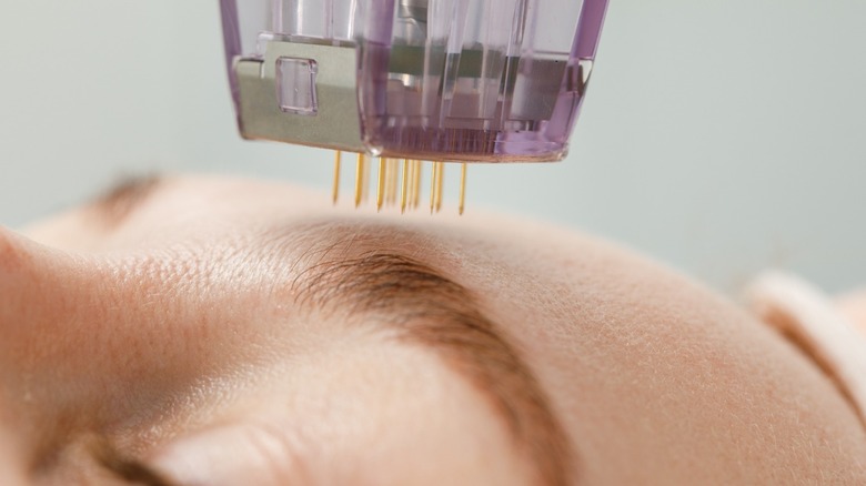 Woman during microneedling