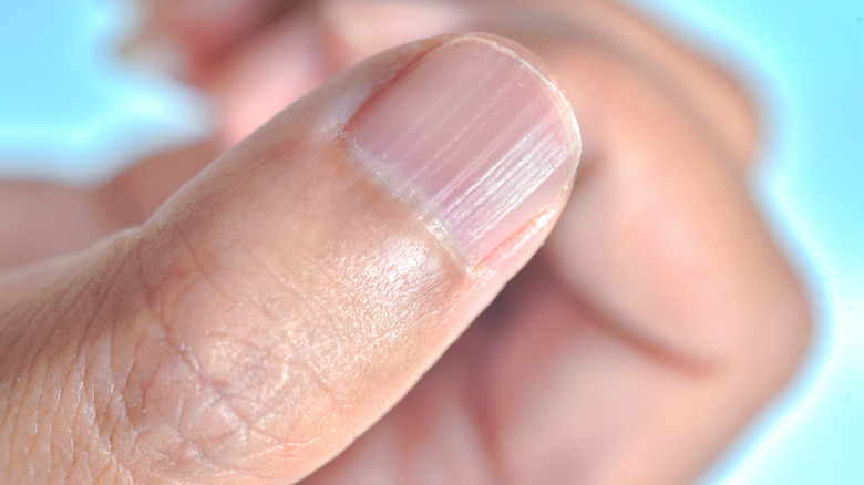 fingernail ridges