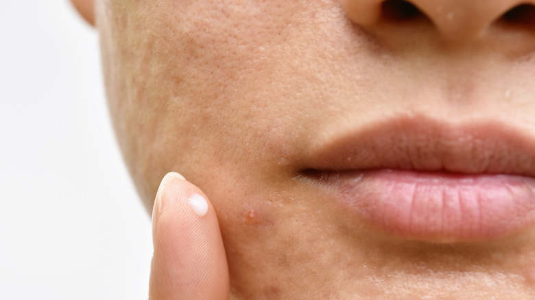 What To Do After You Pop That Stubborn Pimple what-to-do-after-you-pop-that-stubborn-pimple