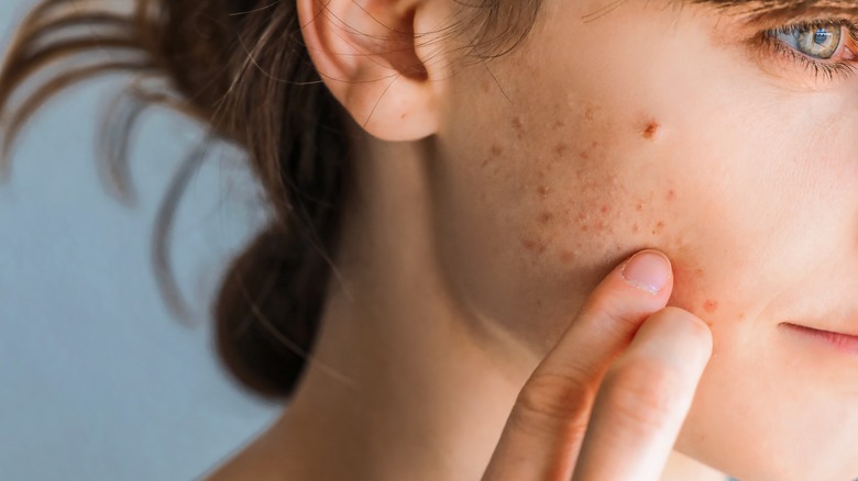 acne on a woman's cheek