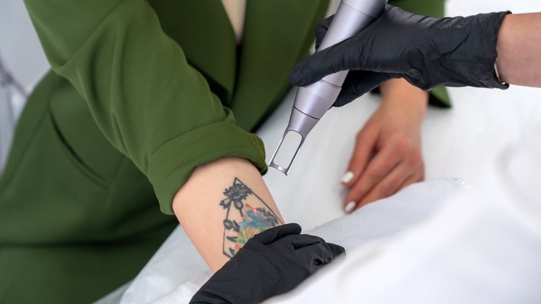 Laser tattoo removal procedure 