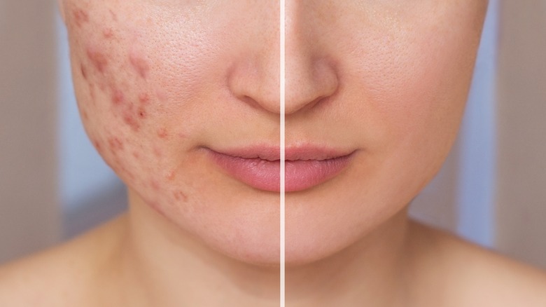 acne scar treatment before after