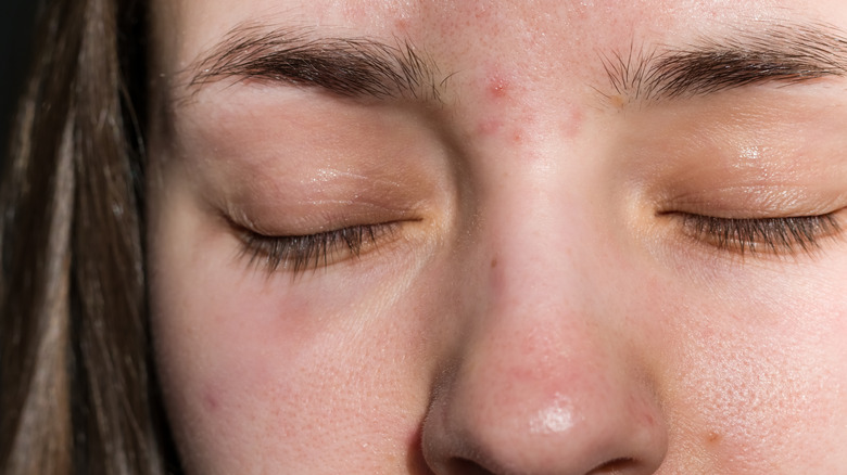 Woman with acne around her eyebrows
