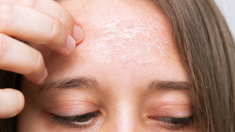 girl touching flaking forehead