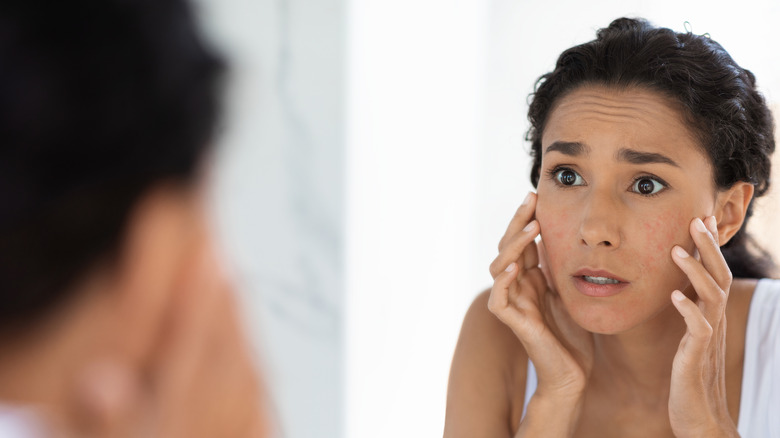 woman with breakouts on chin