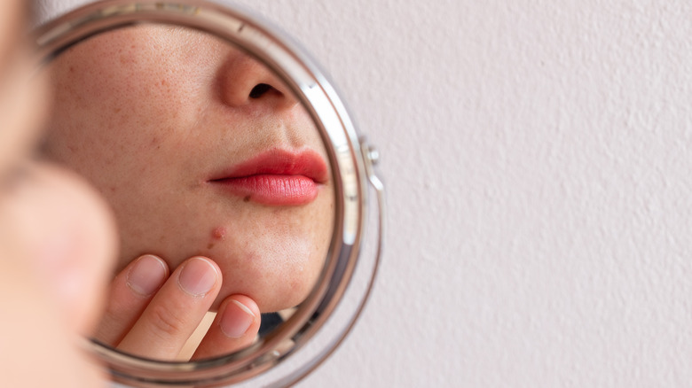 woman worried about acne in mirror