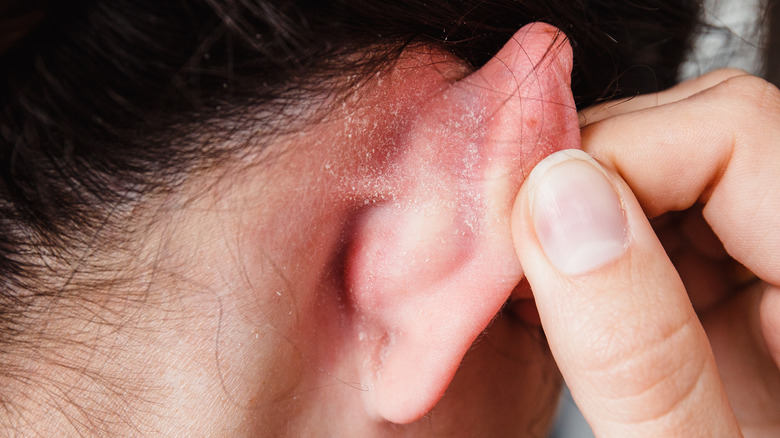 Dry skin behind woman's ears
