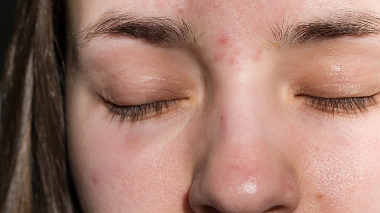 Woman with acne around her eyebrows