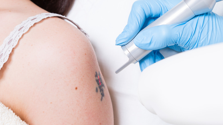 tattoo removal 