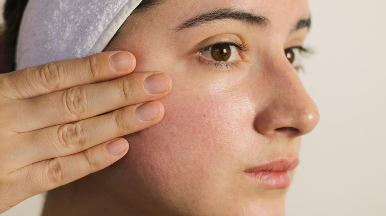 woman with rosacea on cheeks