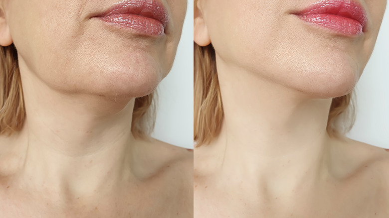 chin fillers before and after