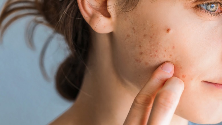 Woman touching her acne