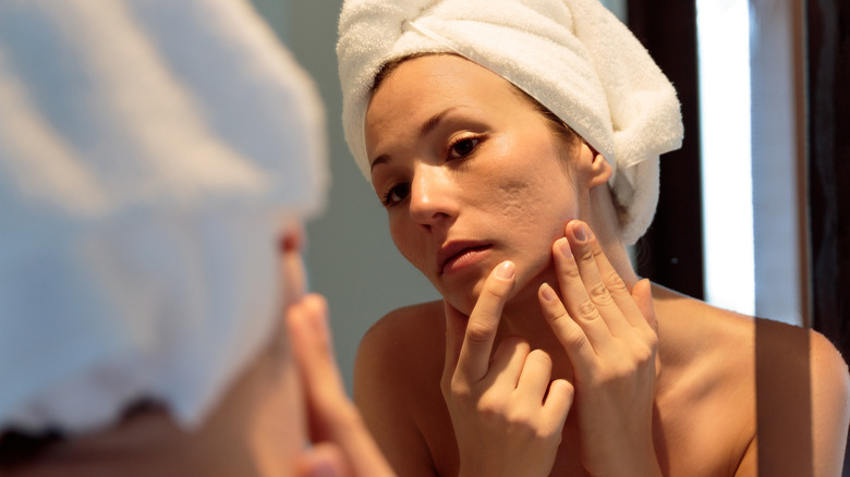 woman with acne scarring